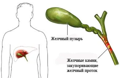 Симптомы хронического холецистита