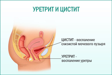 Уретрит у женщин: причины и симптомы