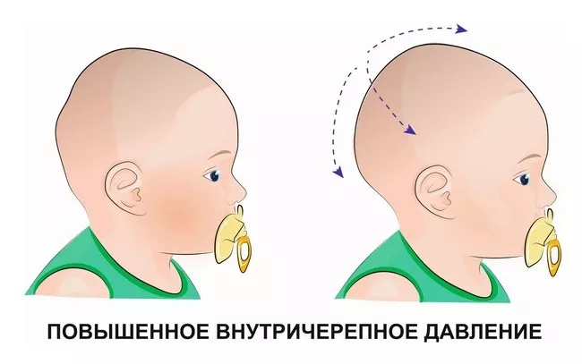 Головная боль
