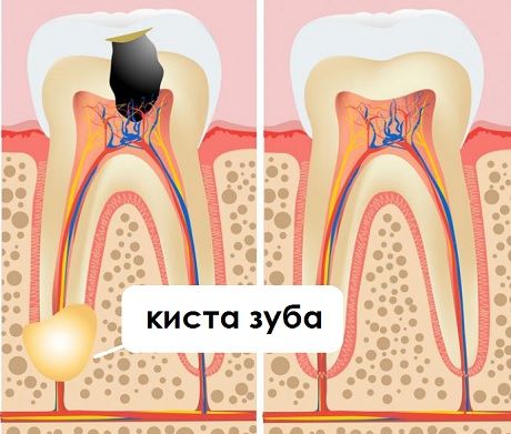 Киста зуба: общая информация