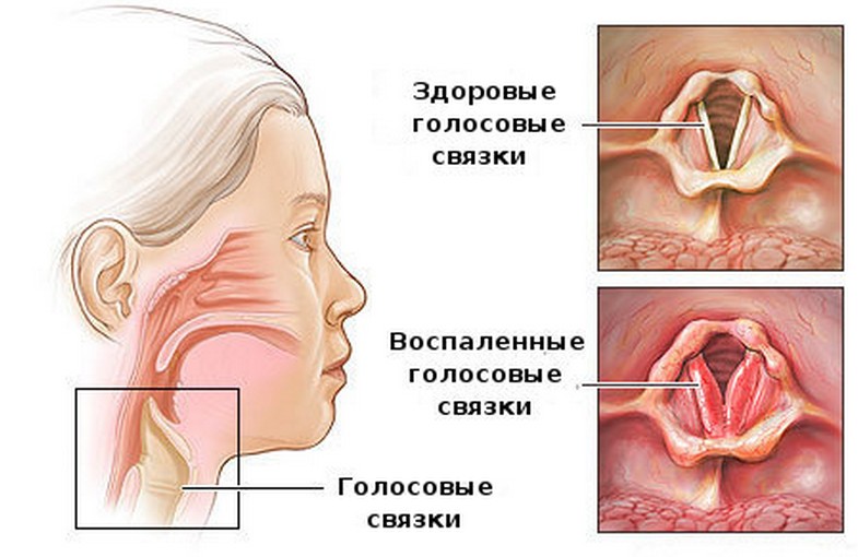 Возможные паразиты, вызывающие боль в горле: