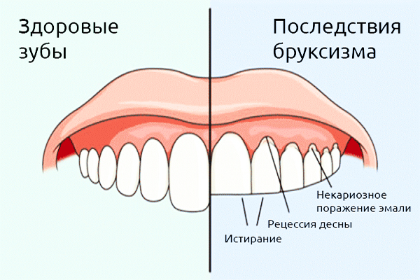 Почему возникает скрежет зубов у взрослых и детей во сне?