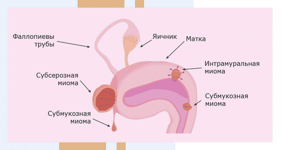 Причины появления миомы