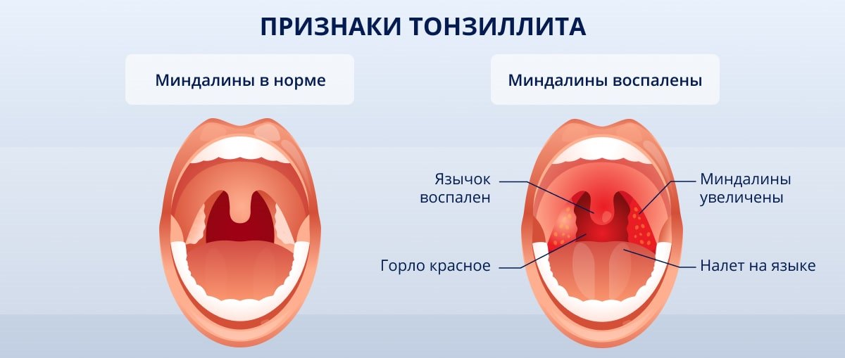 Ключевые рекомендации для предотвращения ангины у детей: