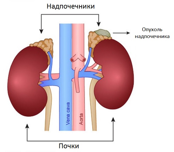 Причины возникновения кортикостеромы надпочечника