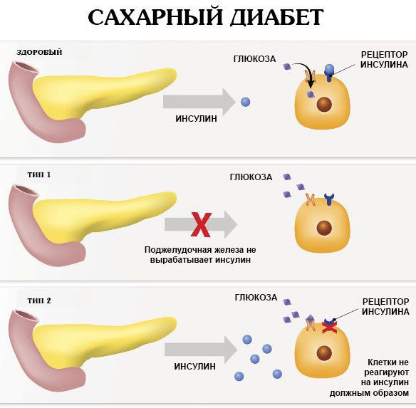 Контроль уровня сахара в крови