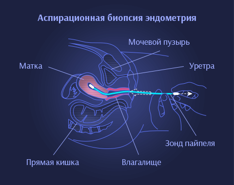 Диагностика расстройств эндометрия