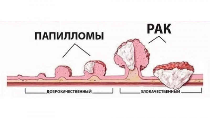 Влияние человека на вирус папилломы