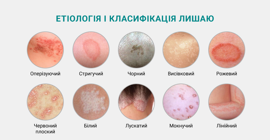 Примеры популярных лекарств от лишая