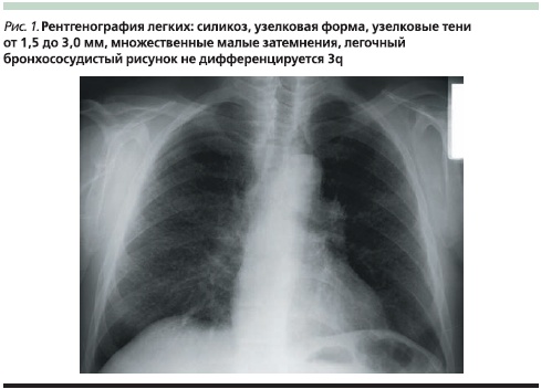 Симптомы силикоза легких