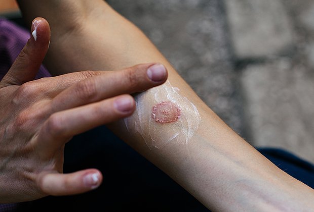 Как диагностировать лишай