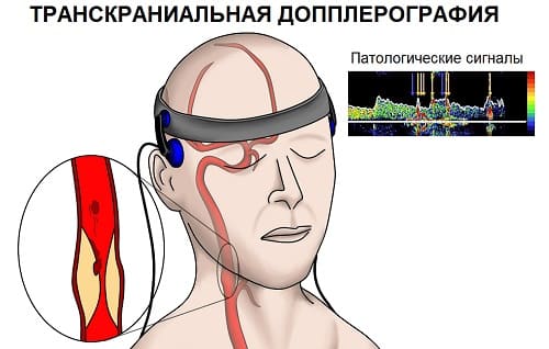 Грипп или простуда