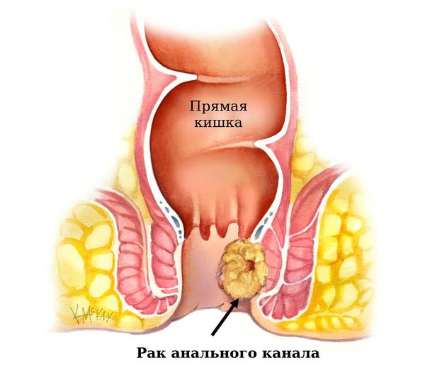 Анальные трещины
