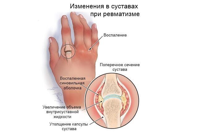 Лечение ревматизма