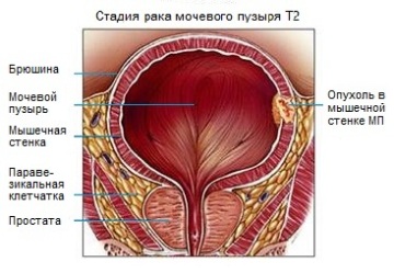 Методы лечения рака мочевого пузыря