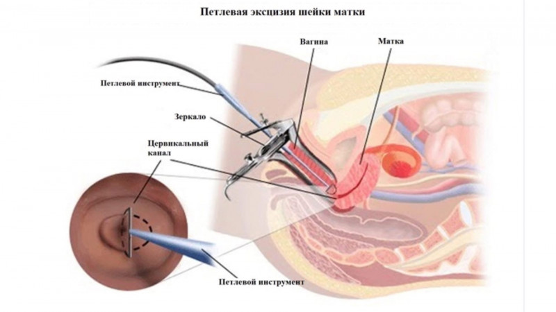 Последствия и осложнения радиоэксцизии шейки матки