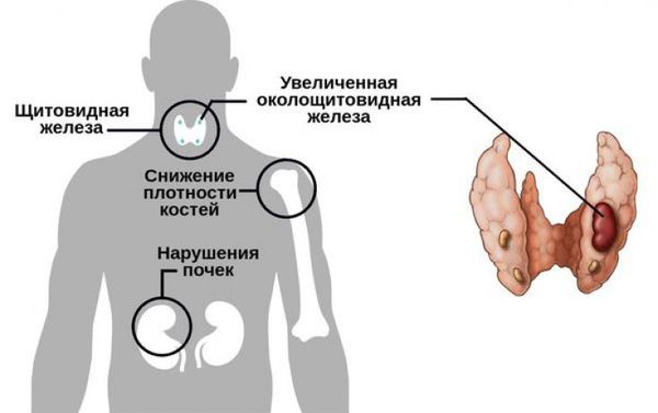 Основные симптомы аденомы паращитовидных желез