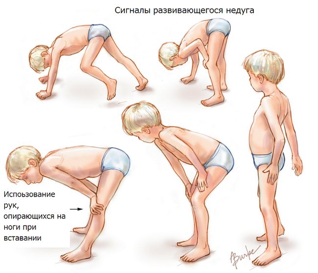 Миопатия Дюшенна: основные симптомы и причины
