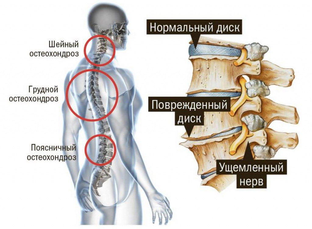 Физическая активность и упражнения при остеохондрозе с отдачей в молочную железу
