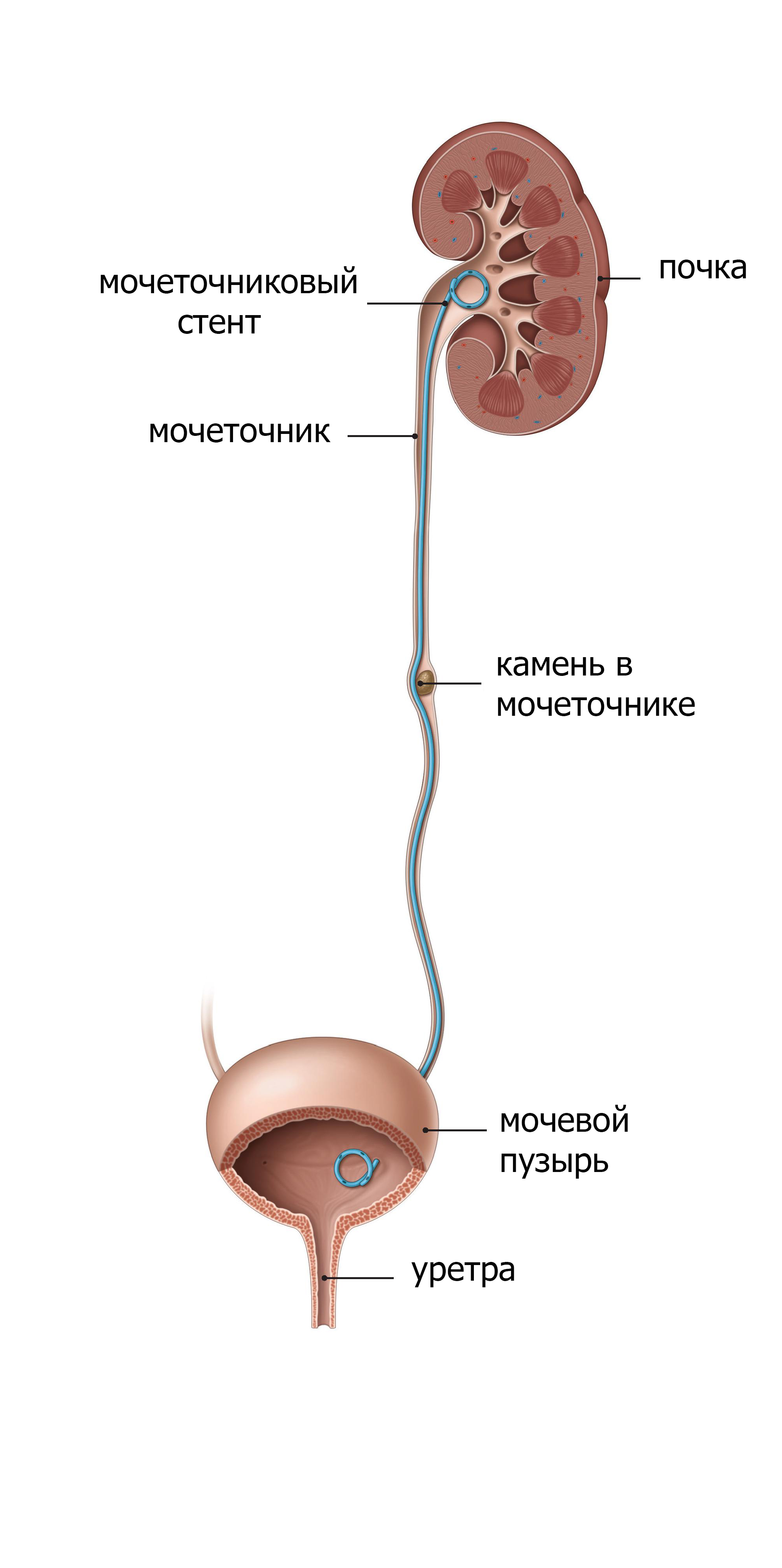 После установки стента в мочеточнике