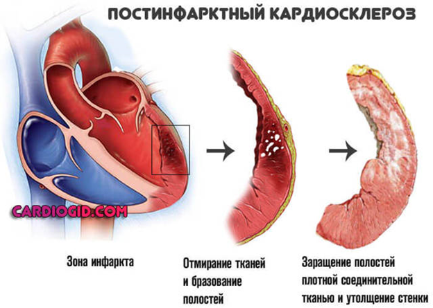 Развитие постинфарктного кардиосклероза