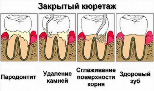 Основные технологии проведения кюретажа