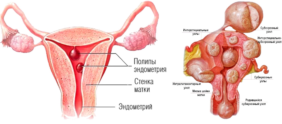 Методы диагностики полипов в матке