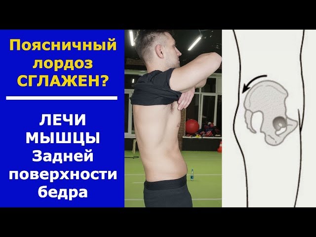 Упражнения для лечения лордоза