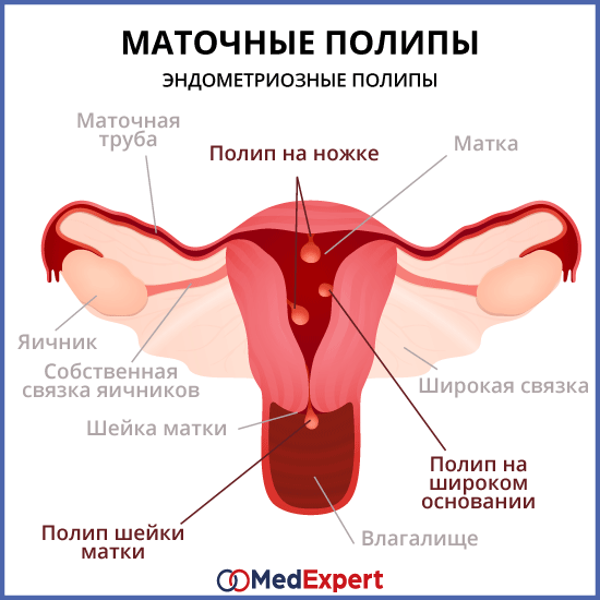 Модерные методы обследования для выявления полипов в матке