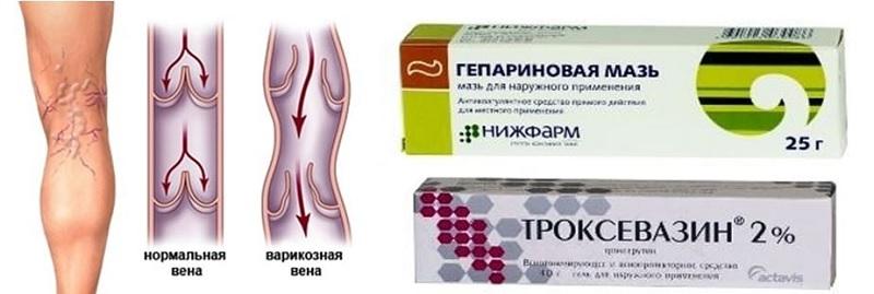 Последствия варикозной болезни включают:
