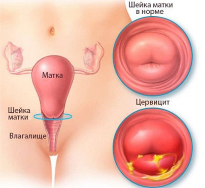 Предупреждение гиперемированной шейки матки