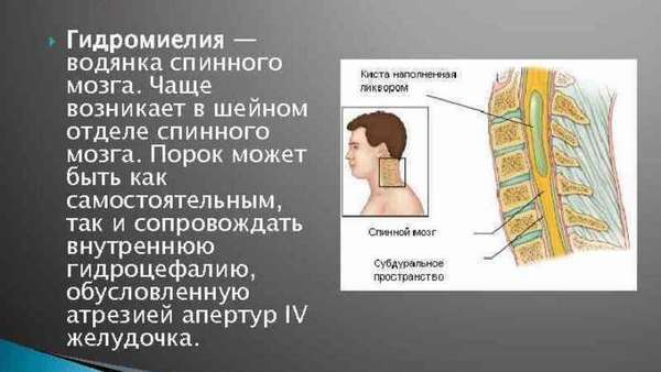 Симптомы гидромиелии