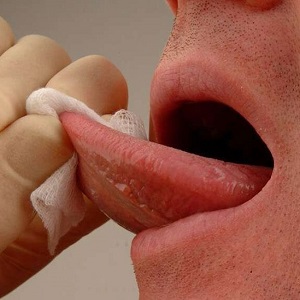 Как поступить при кровотечении из языка Как поступить при кровотечении из языка