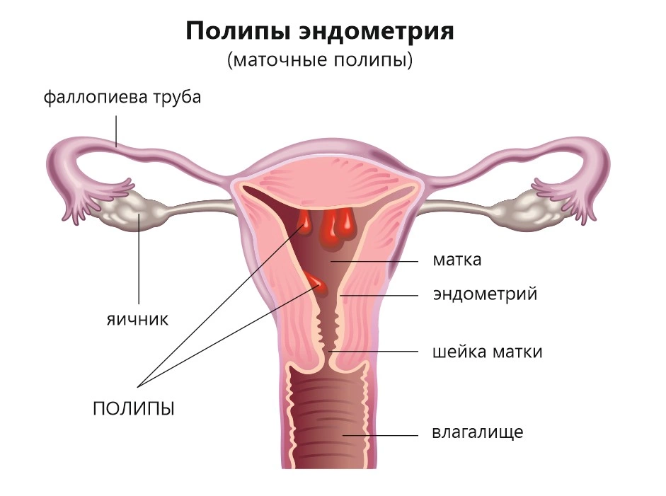 Как определить отклонение матки?